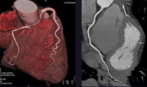Coronary Angiogram 1